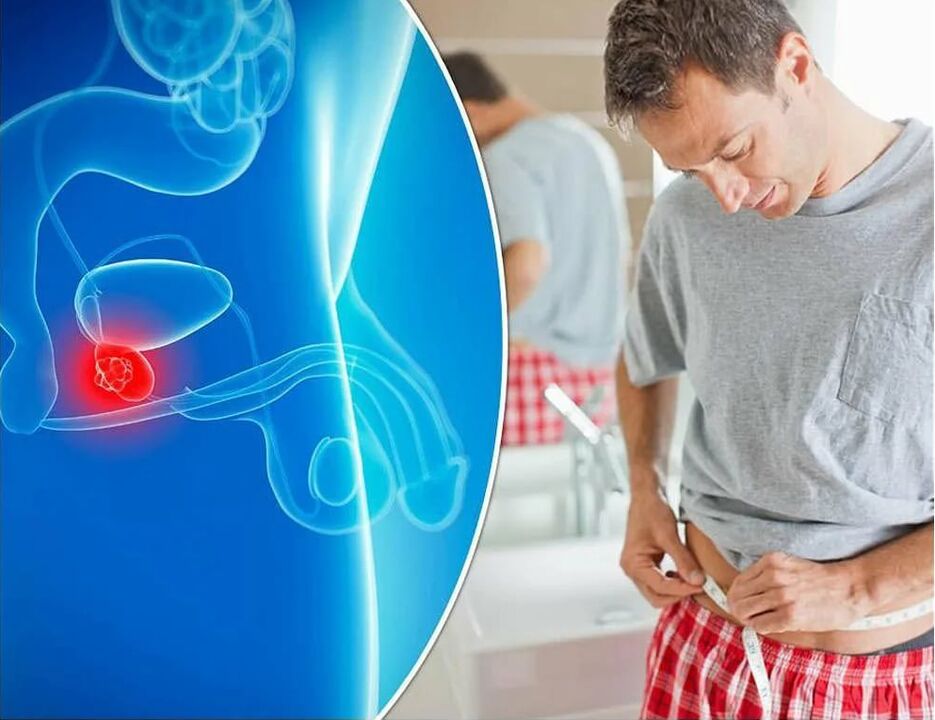 Symptômes et causes de la prostatite