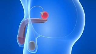 massage de la prostate pour la prévention de la prostatite