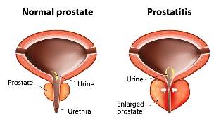 le traitement de la prostatite aiguë