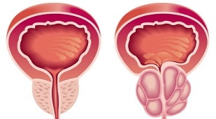 raisons du développement de la prostatite et de l'adénome de la prostate