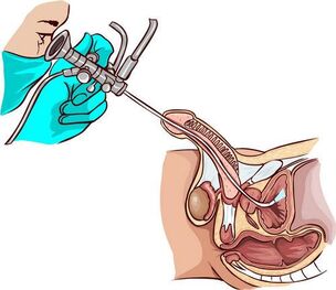 Procédure d'urétéroscopie